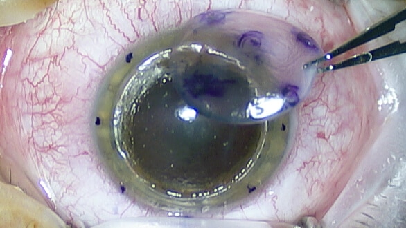 eye retina transplant surgery