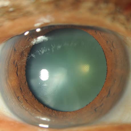 Dr. Vital, A Leading Cataract Surgeon In Houston Explains Cataracts