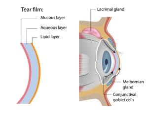 Meibomitis - Mark C. Vital, M.D.